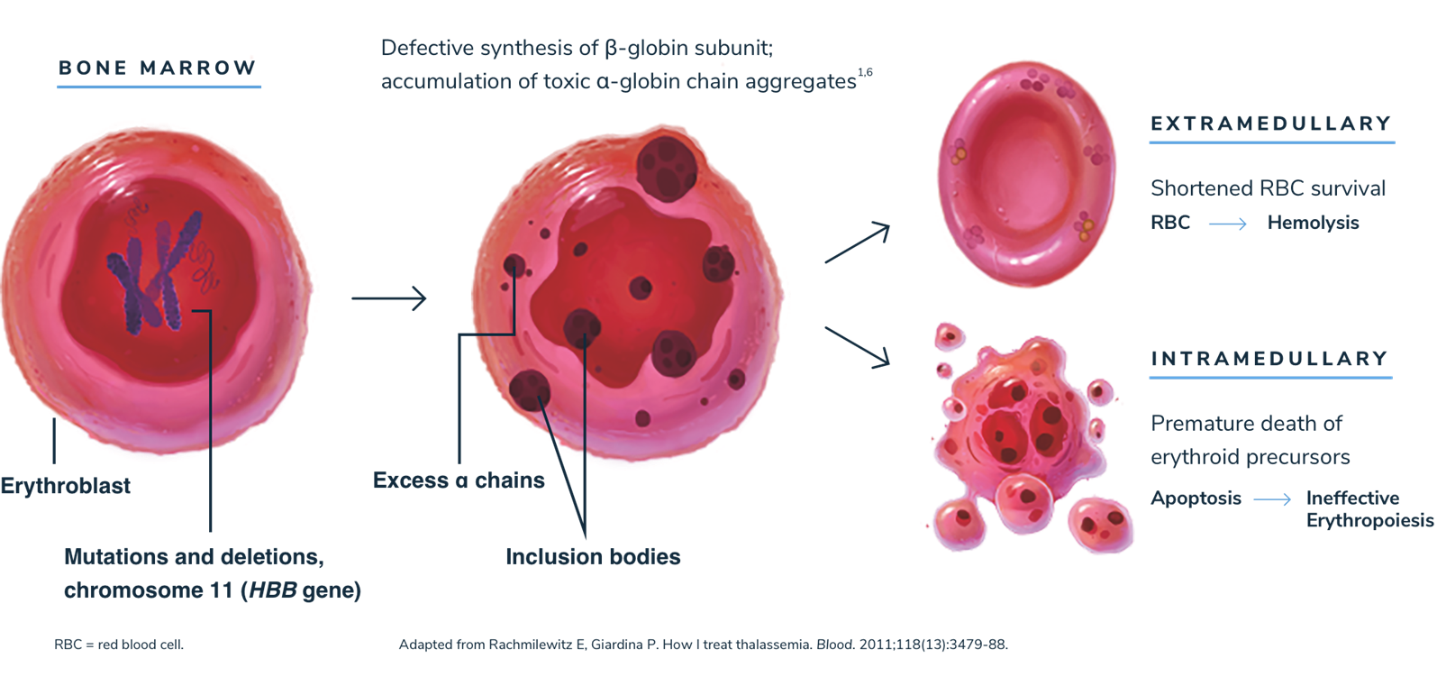 Illustration showing beta-thalassemia pathophysiology via ineffective erythropoiesis and hemolysis