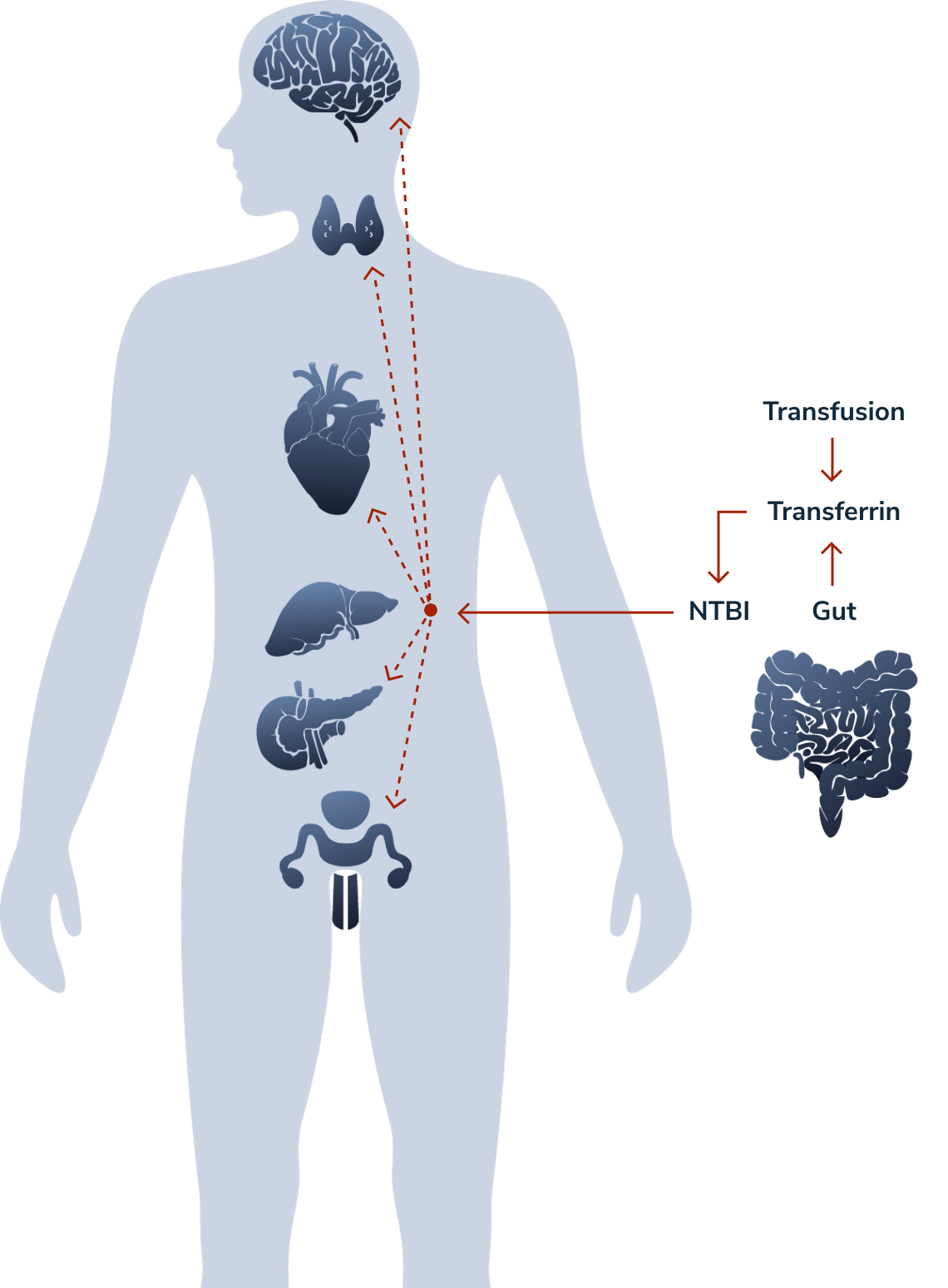 Illustration showing the risks iron overload creates in livers, endocrine glands, and heart 