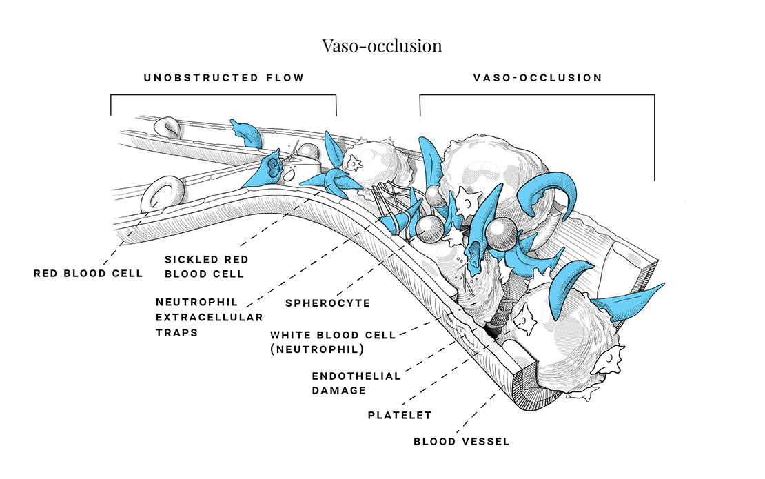 Image showing vaso-occlusion which can lead to vaso-occlusive events