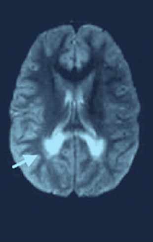 Scan of brain experiencing initial symptoms