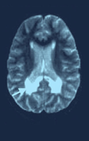 Scan of brain experiencing moderate disability