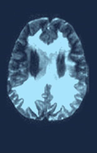 Scan of brain experiencing major functional disability