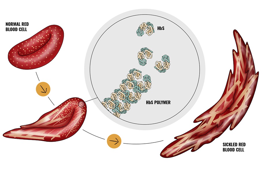 Image of normal red blood cell and sickled red blood cell 	