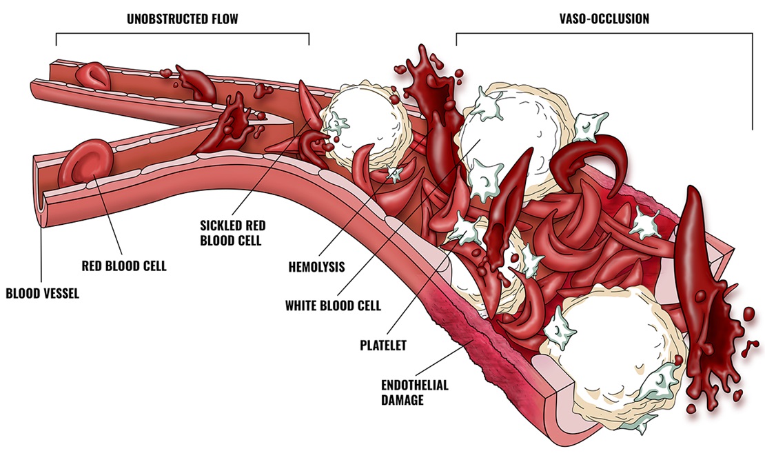 Image showing sickling within blood vessels