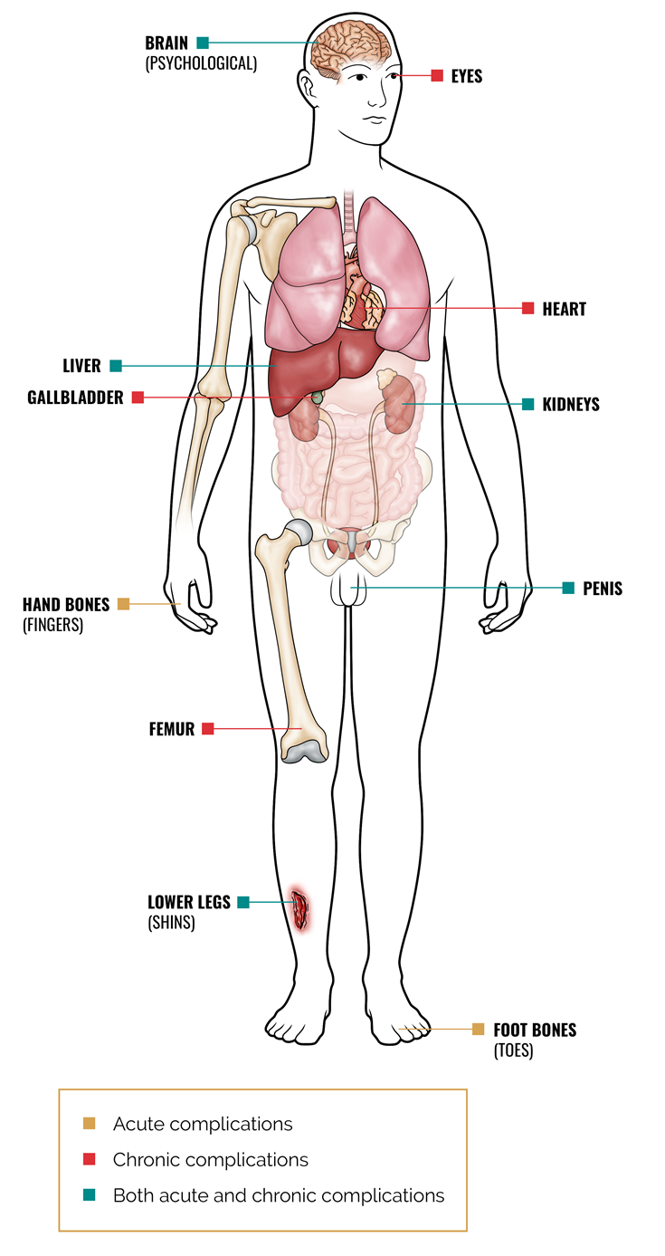 Areas of the body potentially impacted by acute and chronic vaso occlusive events