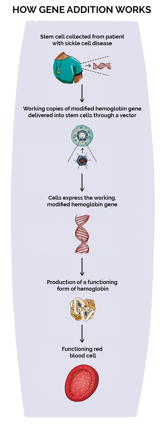 How gene addition works for sickle cell disease