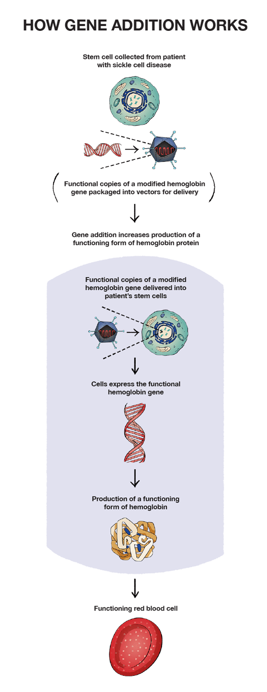 How gene addition works for sickle cell disease