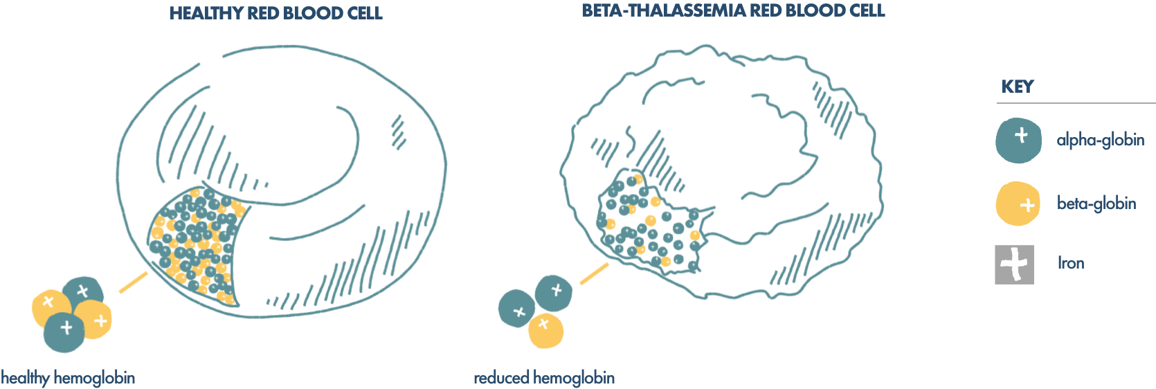 Illustration of a healthy red blood cell vs. a beta thalassemia red blood cell