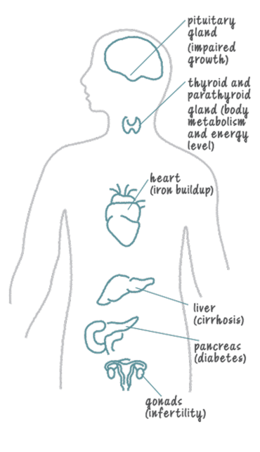 Iron overload from regular red blood cell transfusions can cause issues in organs, including the heart, liver, pancreas, pituitary gland, thyroid, and gonads